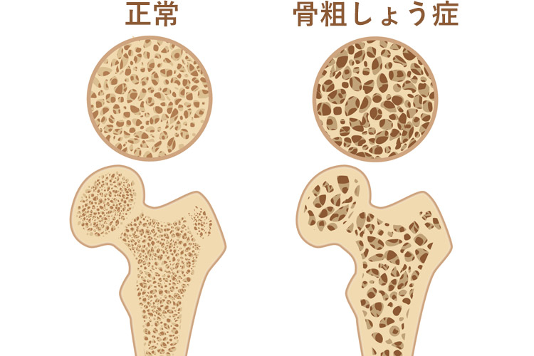 骨粗しょう症のイメージ写真